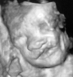 3D ultrasound of Natasha