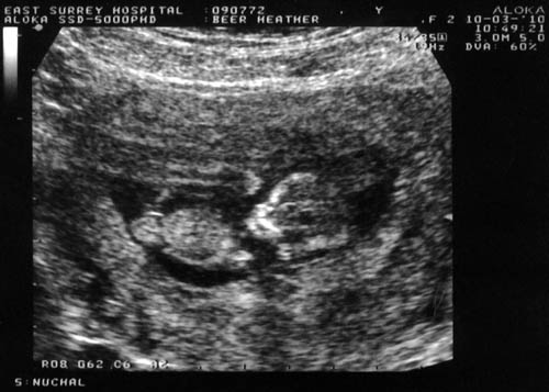 12 week scan of Natasha's sibling